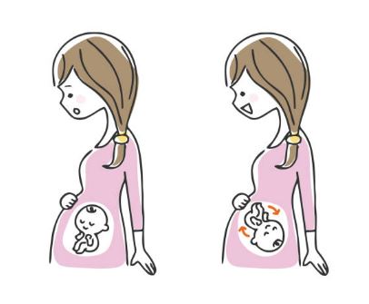 Bakit nagiging suhi ang baby na pinagbubuntis